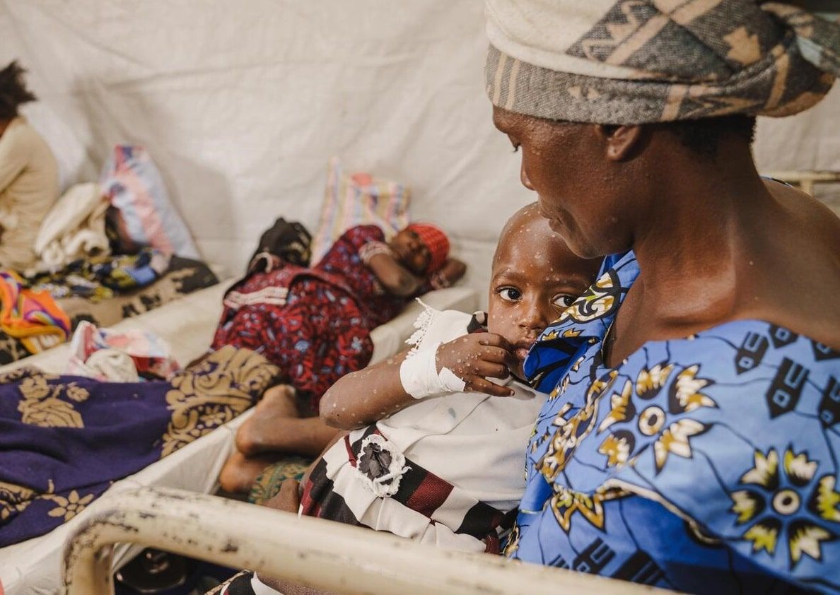 A mother holds her child suffering from mpox at the isolation unit of the UNICEF-supported Kavumu Hospital in South Kivu province, DR Congo