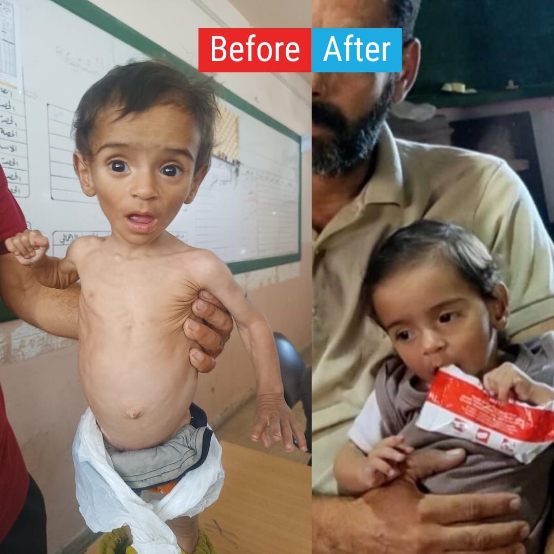 The life-saving effects of the treatment Odai received against SAM (Severe Acute Malnutrition).