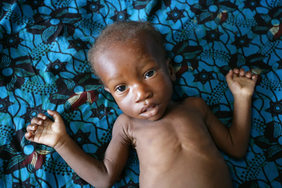 Zinnah, una niña de un año con desnutrición severa, recibe atención en un centro apoyado por UNICEF en Liberia