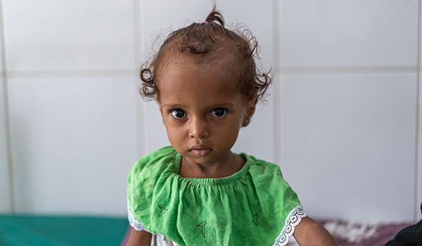 Gosson, child in Yemen with malnutrition