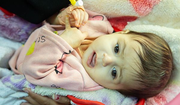 Fatima, child with malnutrition in Yemen
