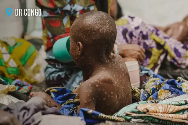 A child suffering from mpox